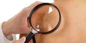 Borgo. 240 visite gratis per la prevenzione del melanoma. Come fare